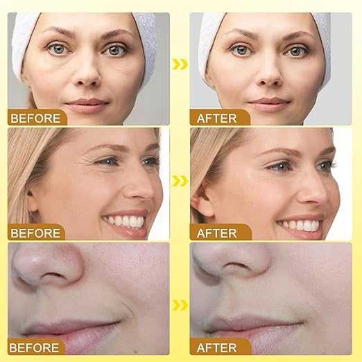 Flat 50% Off Botox Bee Venom Cream